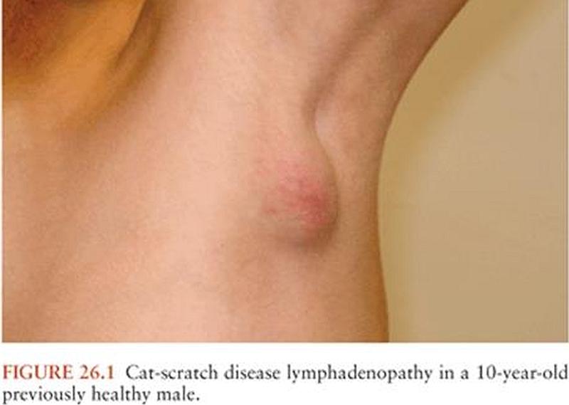 Увеличение подмышечных лимфатических узлов у ребёнка 10 лет | Болезнь кошачьей царапины Увеличение подмышечных лимфатических узлов у ребёнка 10 лет | Болезнь кошачьей царапины