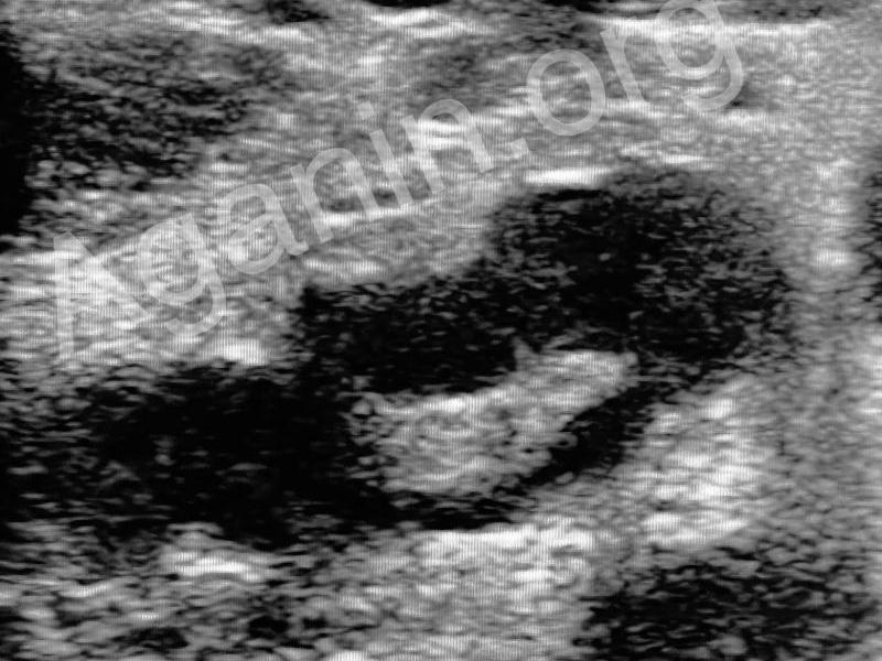 Пакет воспаленных подмышечных лимфоузлов на УЗИ | Болезнь кошачьей царапины Пакет воспаленных подмышечных лимфоузлов на УЗИ | Болезнь кошачьей царапины