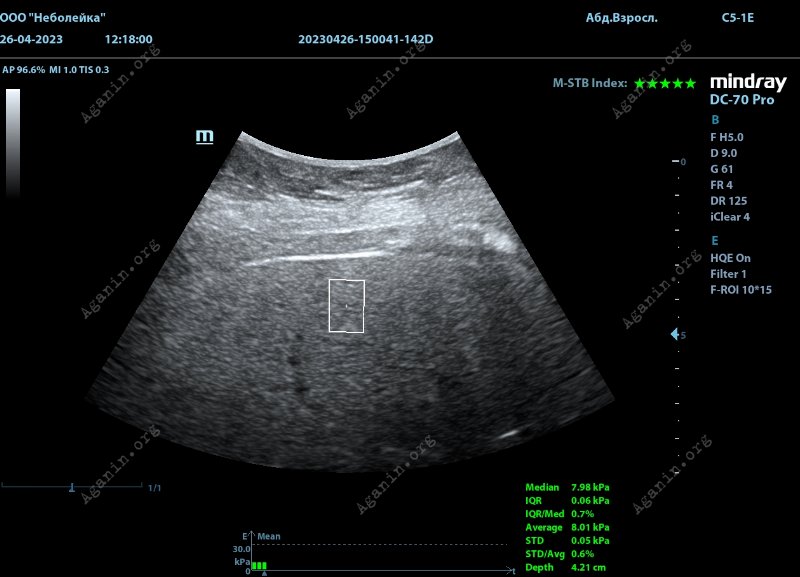 Итоговый результат эластографии печени выглядит примерно так | Фиброскан или эластография печени Итоговый результат эластографии печени выглядит примерно так | Фиброскан или эластография печени