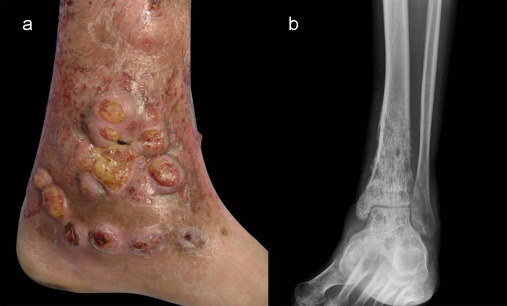 Фузариоз с поражением костей и кожи by P. Campos-Macías et al. / Medical Mycology Case Reports 2 (2013) 128–131 https://doi.org/10.1016/j.mmcr.2013.06.004 Лицензия Attribution-NonCommercial-NoDerivs 3.0 Unported (CC BY-NC-ND 3.0) | Фузариоз человека Фузариоз с поражением костей и кожи by P. Campos-Macías et al. / Medical Mycology Case Reports 2 (2013) 128–131 https://doi.org/10.1016/j.mmcr.2013.06.004 Лицензия Attribution-NonCommercial-NoDerivs 3.0 Unported (CC BY-NC-ND 3.0) | Фузариоз человека