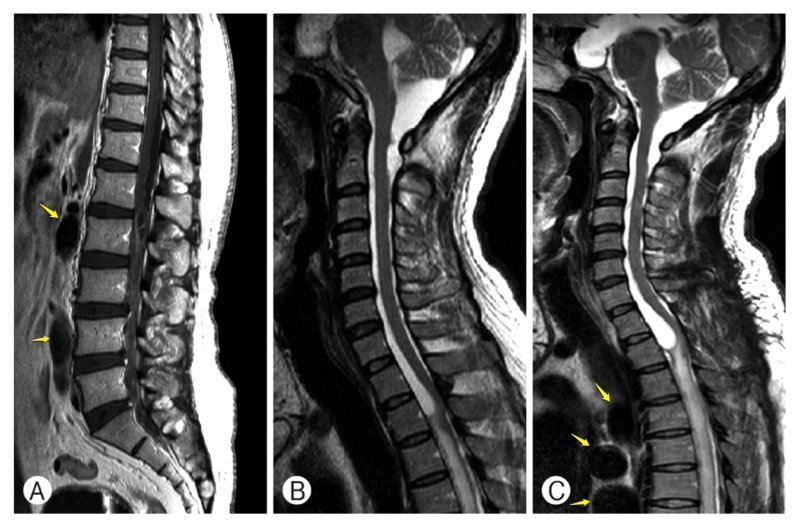 Спинальный нейроцистицеркоз. Стрелки указывают на цисты. Han Joo Lee, Moo Sung Kang, Kyung Hyun Kim. Intradural Spinal Cysticercosis: Case Series. The Nerve 2015; 1(1): 20-25. | Тениоз и цистицеркоз Спинальный нейроцистицеркоз. Стрелки указывают на цисты. Han Joo Lee, Moo Sung Kang, Kyung Hyun Kim. Intradural Spinal Cysticercosis: Case Series. The Nerve 2015; 1(1): 20-25. | Тениоз и цистицеркоз